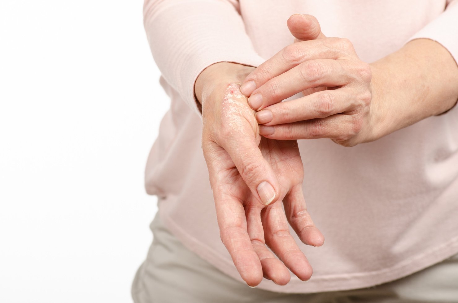 Female hands psoriasis