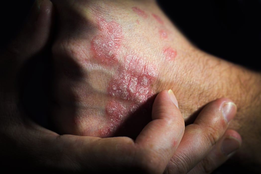 psoriasis is an autoimmune human disease. a man holds a hand at a psoriasis affected area of the skin