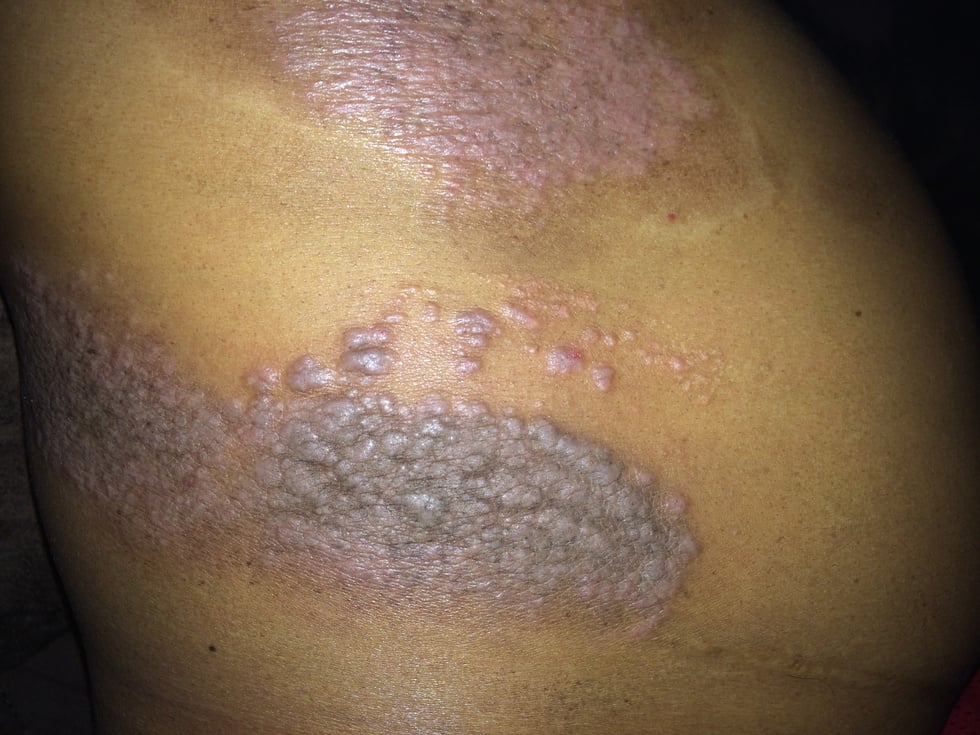 Psoriasis