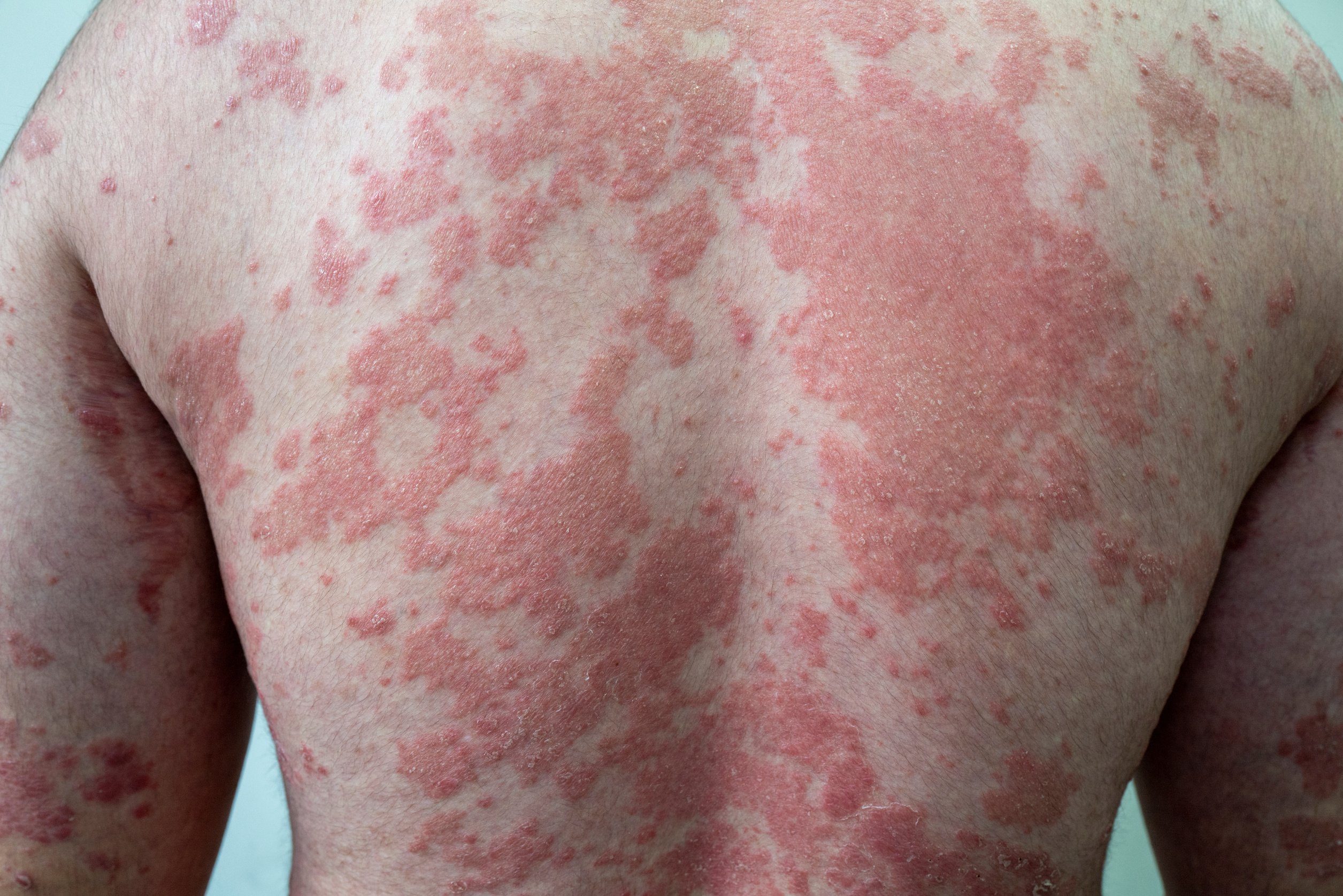 Psoriasis