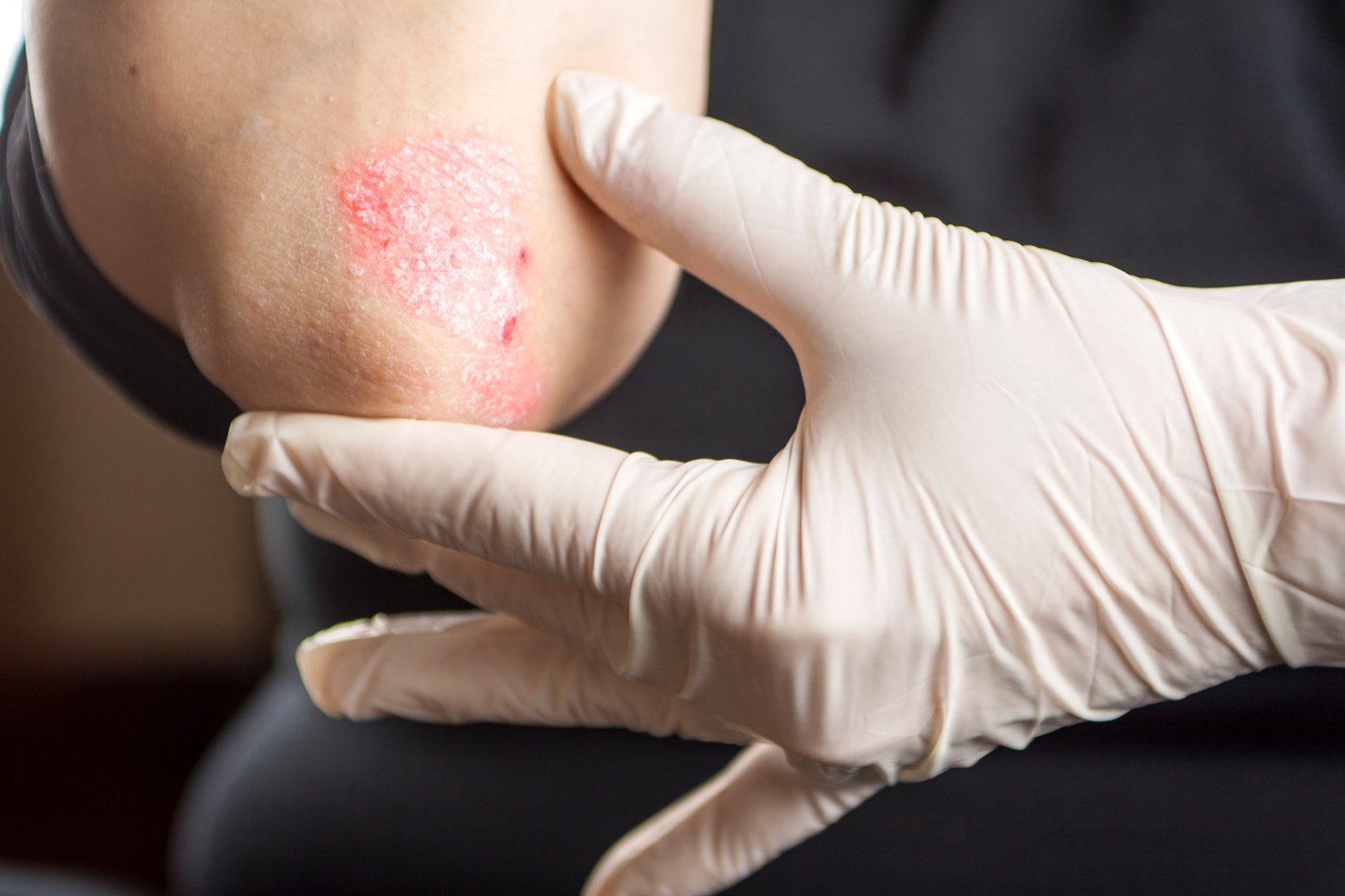 Psoriasis on elbow