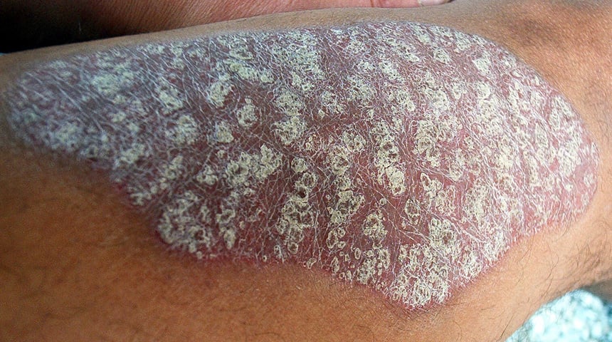 Psoriasis