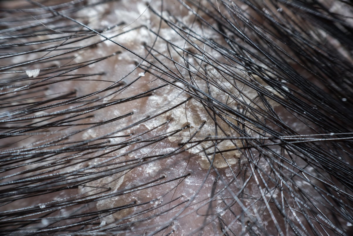 Hair scalp with dandruff and scaly from psoriasis